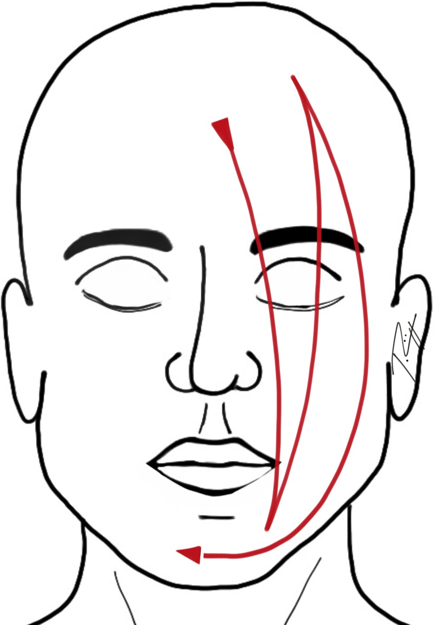 Affusion chaude du visage. Image : J. Rüegger