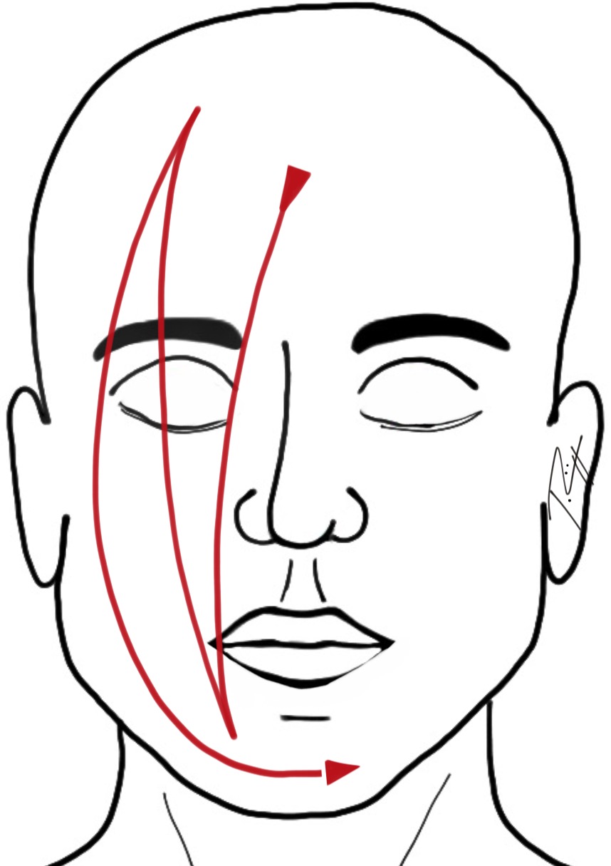 Affusion chaude du visage. Image : J. Rüegger